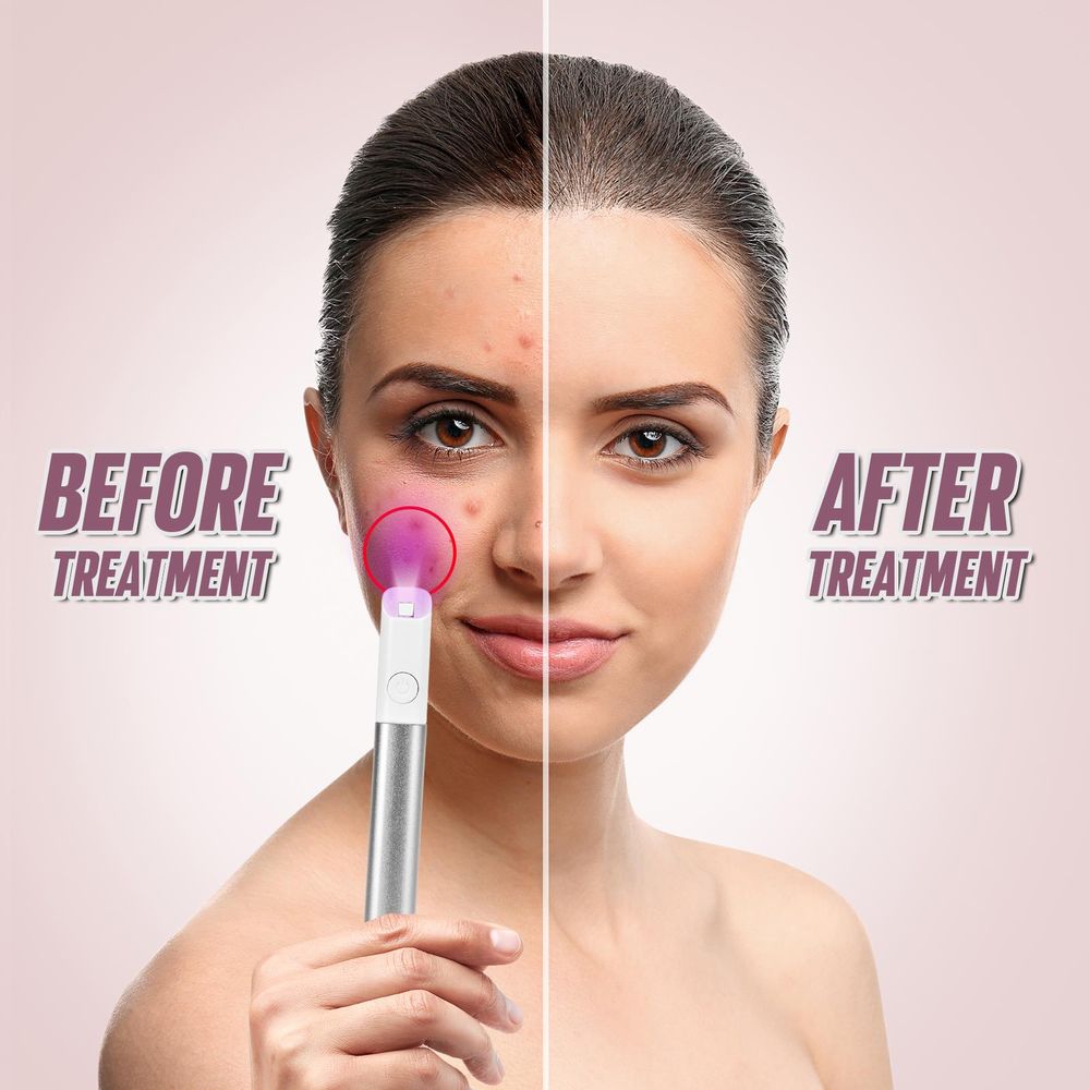 ASAB Light Therapy Acne Spot Treatment - SILVER AS-61683 5056157961683